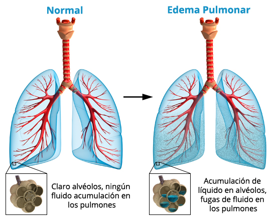 hf_lung_edema_es