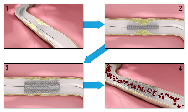 angiostent