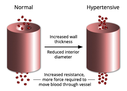 hypertension