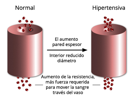 hypertension_es